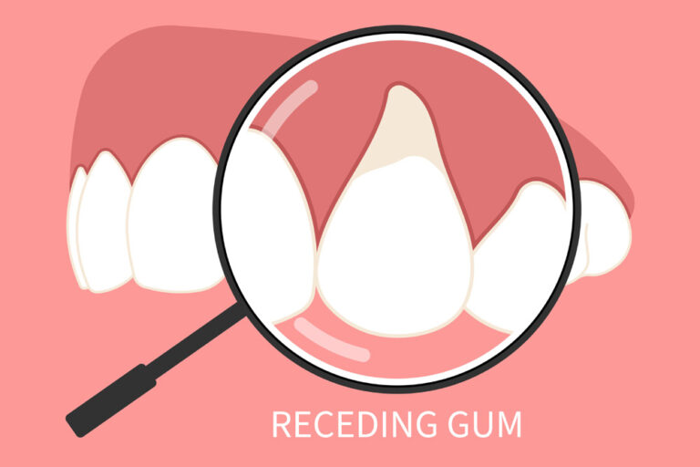receding gum